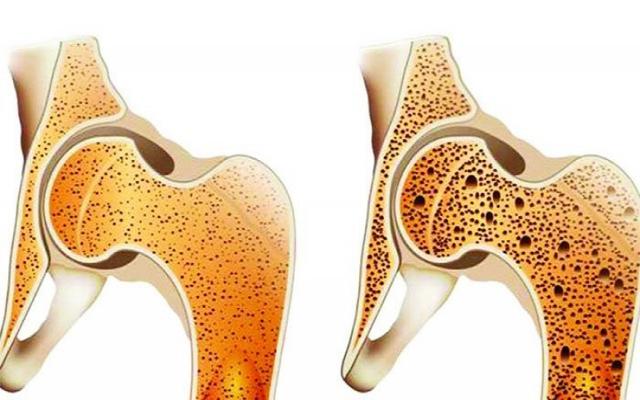 ৩০-৩৫ বছর পর থেকে নারীদের হাড়ের ক্ষয় বাড়ে 