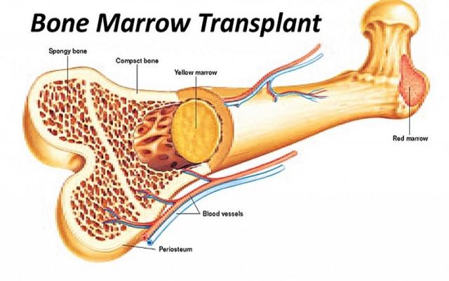 সরঞ্জাম ও প্রশিক্ষণপ্রাপ্ত চিকিৎসকের অভাবে দেশে অস্থি মজ্জা প্রতিস্থাপন সচরাচর না