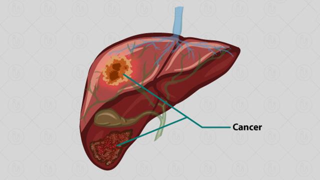 হেপাটাইটিস কী, লিভার সিরোসিস-ক্যান্সার কেন হয়?