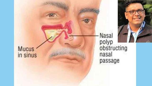 নাকের পলিপ ও তার চিকিৎসা