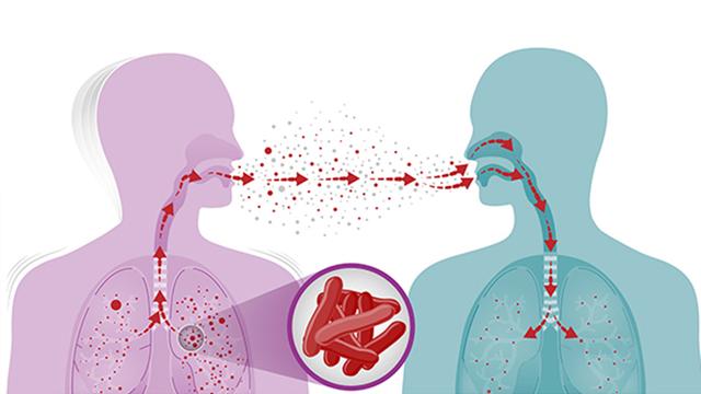 কীভাবে ছড়ায় যক্ষ্মা, লক্ষণ ও প্রতিকার
