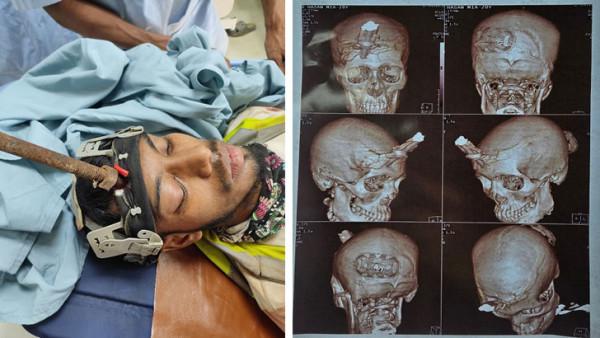 মাথায় ৩ ইঞ্চি দেবে যাওয়া লোহার রড সফলভাবে বের করলেন ইস্ট ওয়েস্ট মেডিকেলের চিকিৎসক